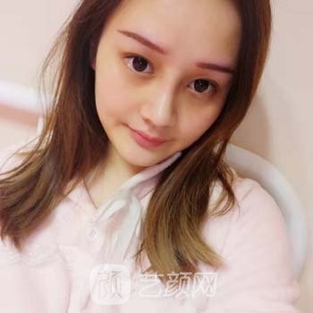 硅胶隆鼻失败修复实例，重塑漂亮、精致鼻部形态