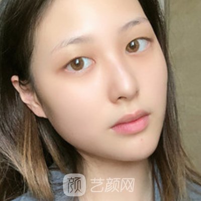南京柏盛医疗整形医院怎么样？崭新双眼皮实例出炉