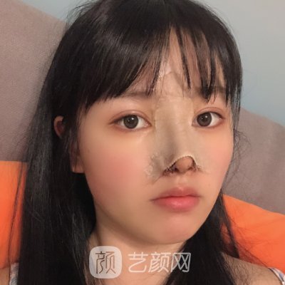 南京市第一医院整形科隆鼻实例展示|这是你想要的成果吗?