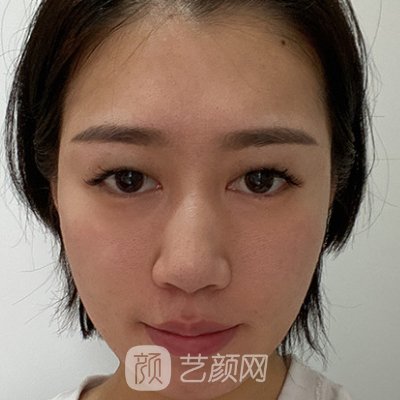 宿州阳光整形医院做面部提升技术好吗？2023实例曝光