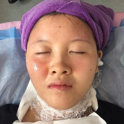 长沙瑞澜医疗美容医院除皱抗衰实例一览|成果自然无痕