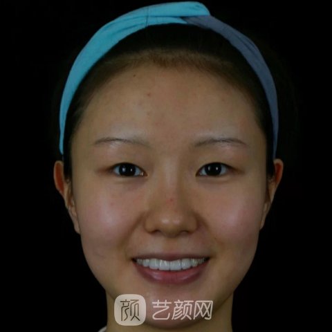 镇江市第一人民医院整形科抗衰除皱实例展示|成果自然无痕