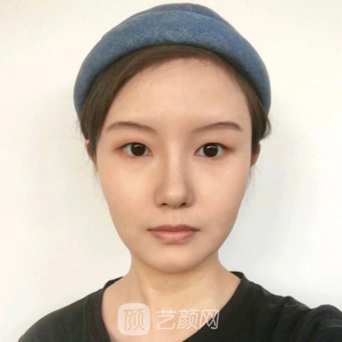 镇江市第一人民医院整形科抗衰除皱实例展示|成果自然无痕