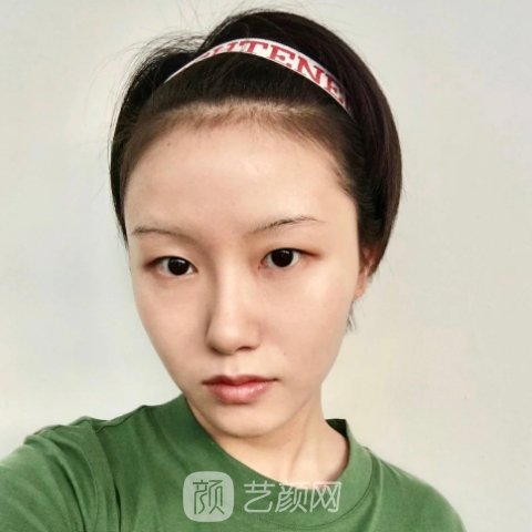 镇江市第一人民医院整形科抗衰除皱实例展示|成果自然无痕