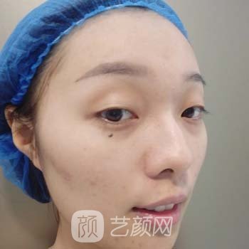 南宁华美整形美容医院价目表|医生简介+双眼皮实例