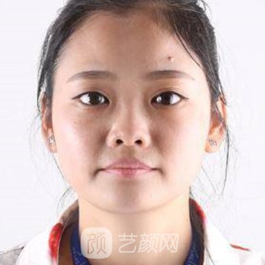 上海王会勇医生做鼻子好吗? 新体验实例公布