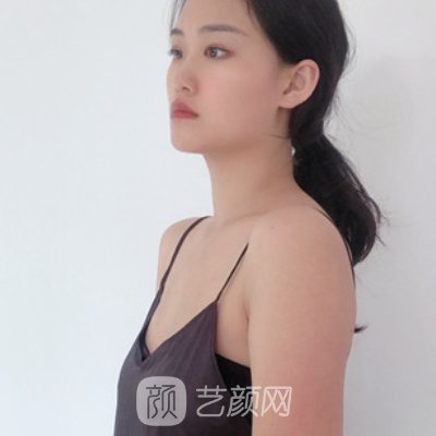 浙一医院整形科正规吗？崭新脂肪隆胸实例发布