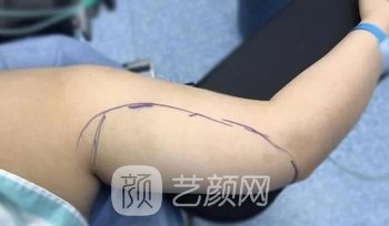 梁耀婵在北京很有名吗？医生详细介绍+手臂吸脂实例