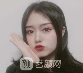 全切双眼皮7毫米修复图，术后稍微化个妆就漂亮的不得了