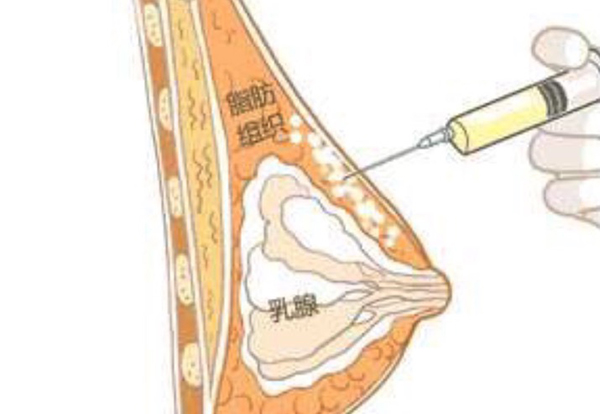 <strong>搜集的北京自体隆胸医生排名榜，北京自体脂肪</strong>